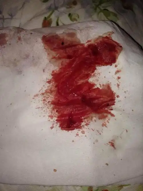 感冒了嗓子很疼还咳嗽鼻子不畅通鼻