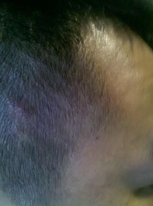 头皮红肿,出现脂肪颗粒,头屑很多,是不是的了皮肤病 什么病 如何治疗?