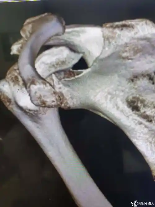 肩锁关节脱位伴喙突骨折