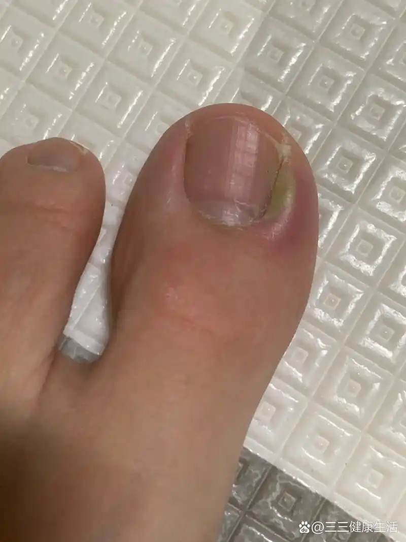 脚指甲引起的炎症治疗