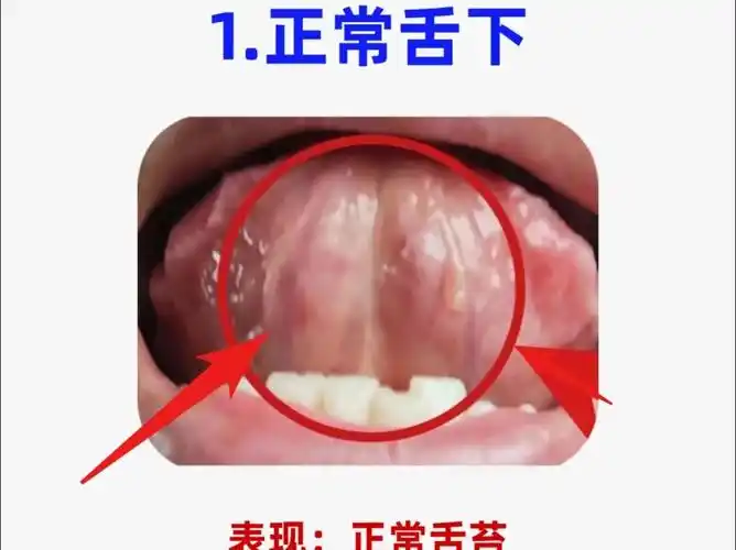 舌诊分析:看舌下辩健康,六种常见舌下,对镜自查