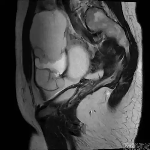 右侧卵巢巧克力囊肿1,你的诊断答案是?2,你的解析思路是?