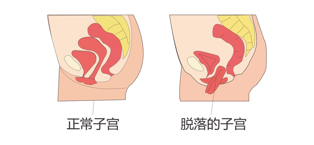 2022年4月19日案例分享子宫脱垂是女性的困扰