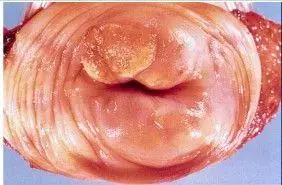 宫颈癌放疗引起尿急等症状怎么办呢