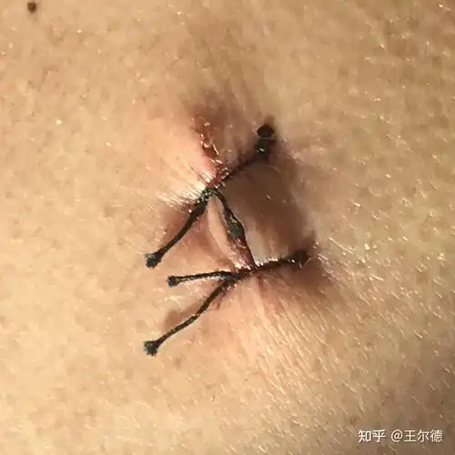 粉瘤手术,已拆线第三天,现在的这个状态能告诉我该如何处理吗? - 知乎