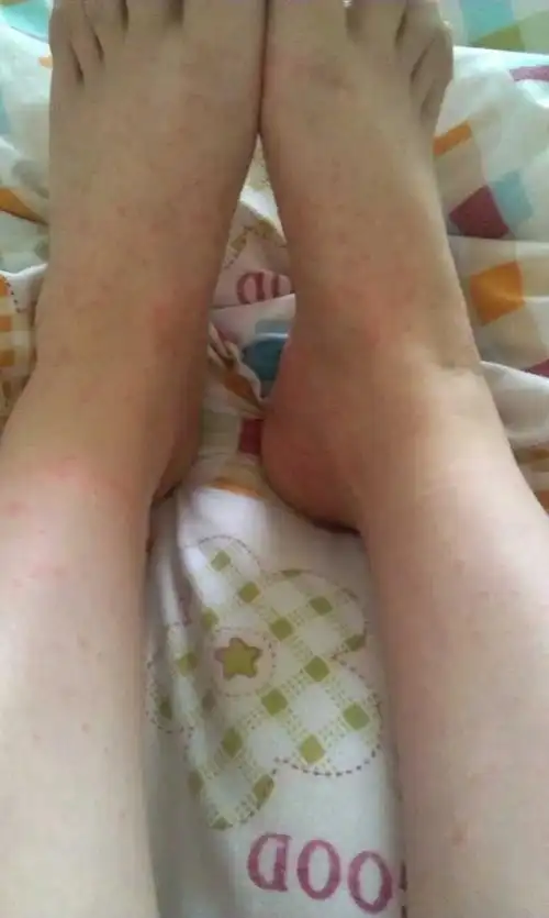 产后妈妈还在月子的时候有没有身上长红疹的