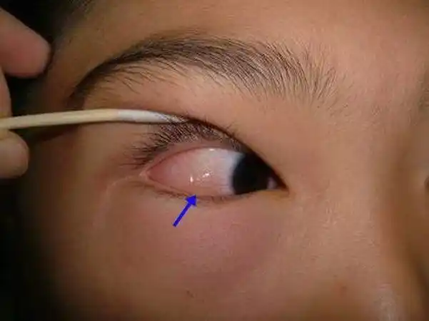 箭头处为眼白结膜急性水肿