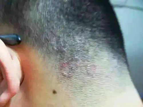 最近 湖北的一位75岁老人周大爷 终于决定去医院看一看 十多年来长在