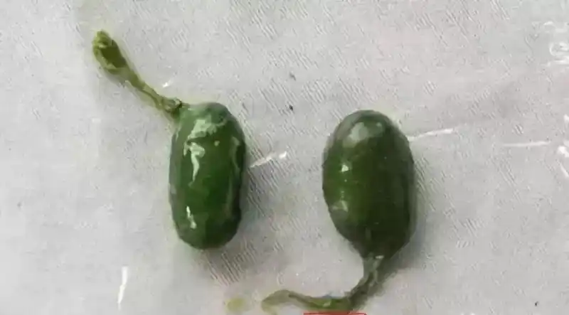 遭得惨丨泸州一小伙用苦胆汁治病,结果吃进重症监护室至今未脱险!