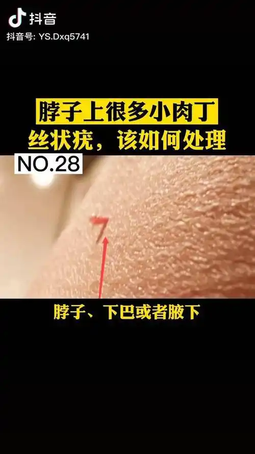 脖子上的这种小肉丝该怎么处理呢丝状疣面部医学科普