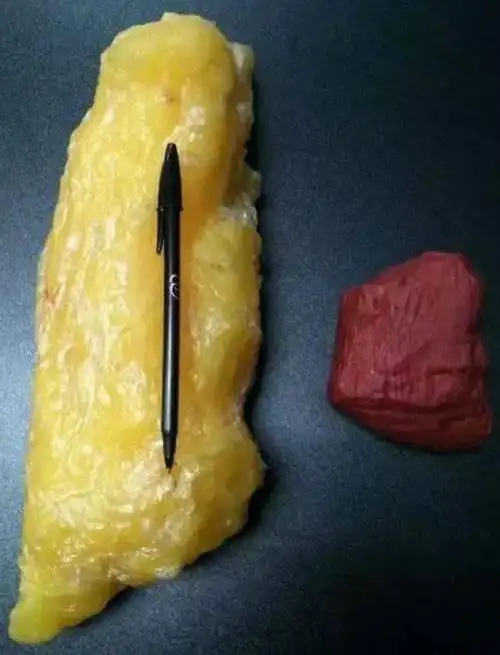 肥胖妈妈肚子脂肪达到了10cm,几经痛苦周折,终于生出了糖宝宝!