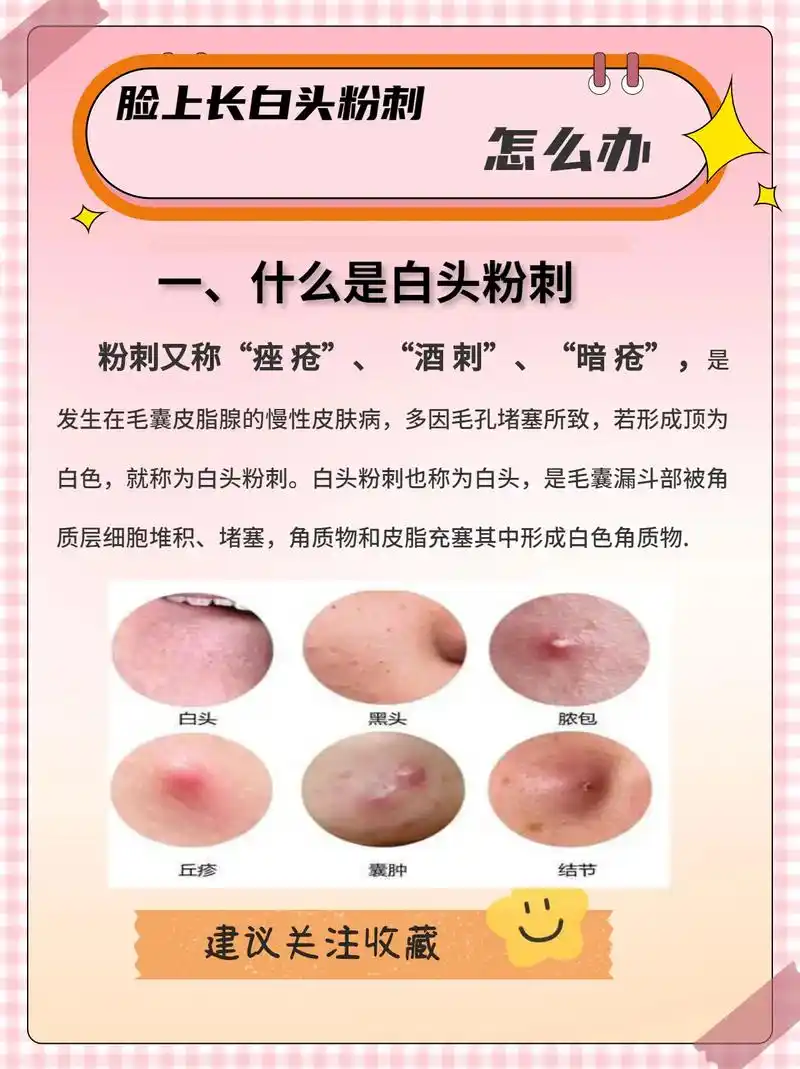 如何正确认识白头粉刺,学到了嘛! #护肤 #护肤分享 #毛孔 - 抖音