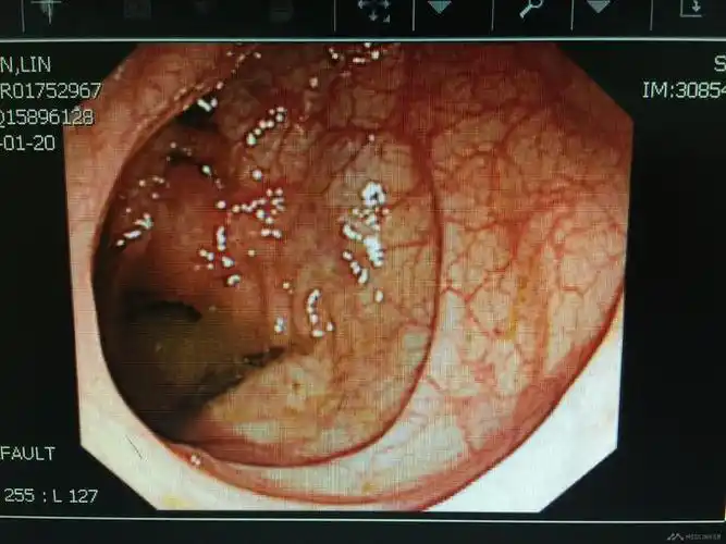 乙状结肠息肉一例