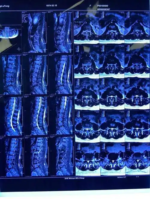 渭南市第二医院神经脊柱外科成功治愈腰5-骶1腰间盘突出症患者