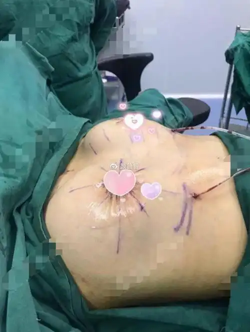 解析胸下垂矫正手术需要多少钱?胸部下垂怎么办?