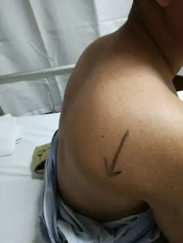 肩膀疼痛原因探秘系列之:介绍一肩关节后侧疼痛肩胛骨下半部骨巨细胞