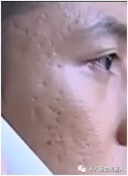 女明星都在积极护肤,男明星的皮肤竟差成这样,坑坑洼洼太吓人!