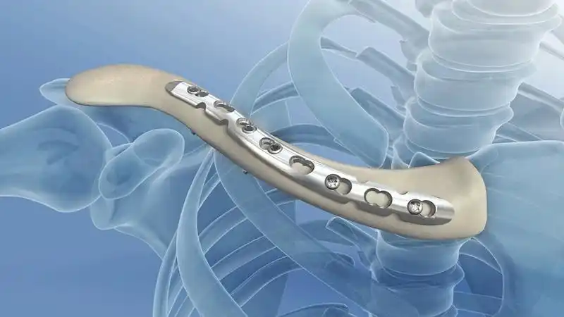 医疗器械——骨钉