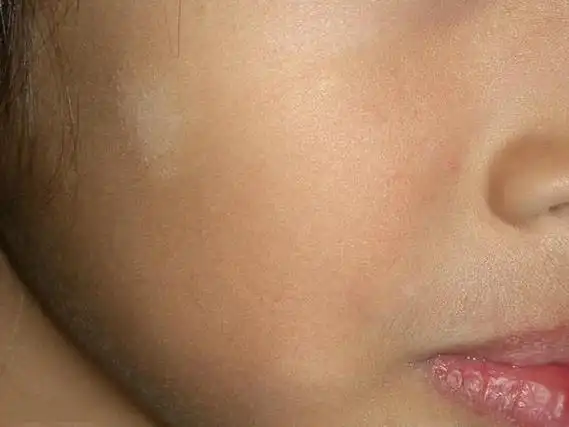 宝宝脸上有白斑说明肚里有蛔虫,要吃打虫药?