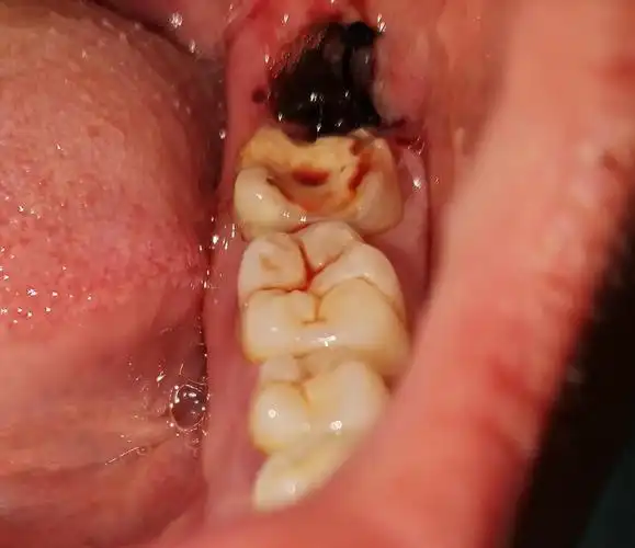 拔智齿的姐妹进来看看有图