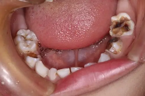 你的孩子爱吃糖吗而糖是蛀牙生成的巨大因素