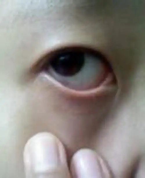 左眼充血性黄斑病变图片