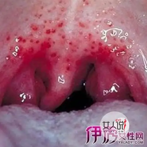 咽喉癌的早期症状,早知道早治疗.看看这里就知了