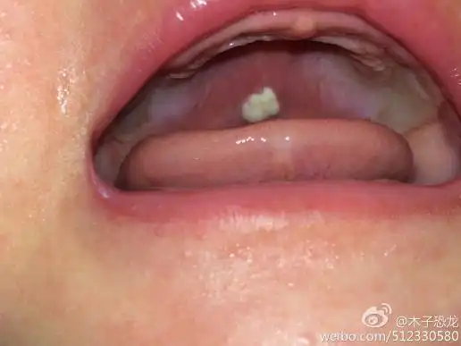 三个月宝宝正常口腔图-是什么情况?崔医生?