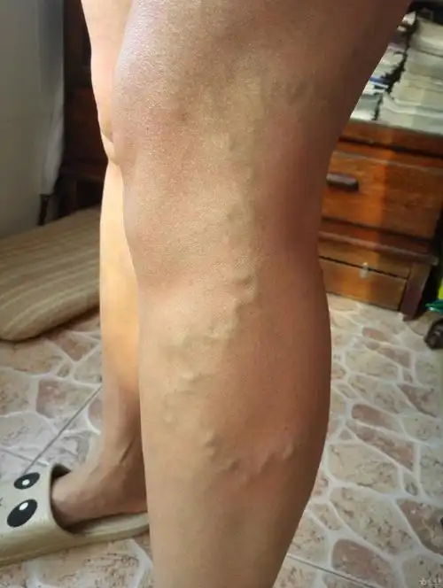 求助:非典型的静脉曲张