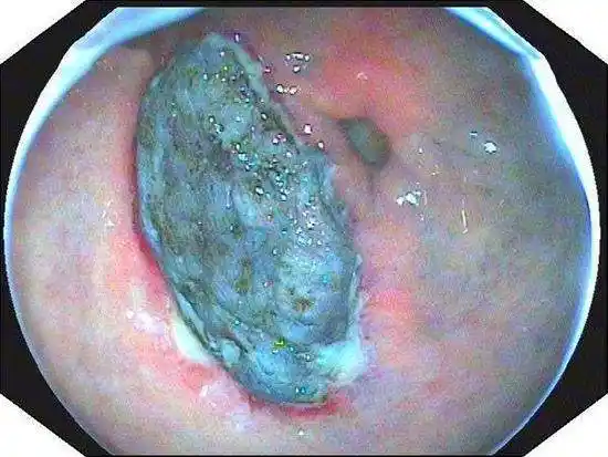 胃溃疡癌变的4大征兆,坚持做1件事可以防止癌变