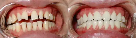 烤瓷牙的优缺点