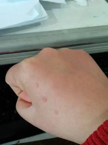 关于扁平疣的问题