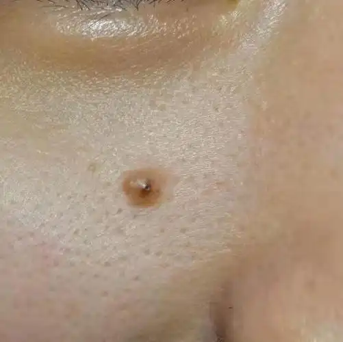 这个是叫做肉痣吗?是不是可以切除?