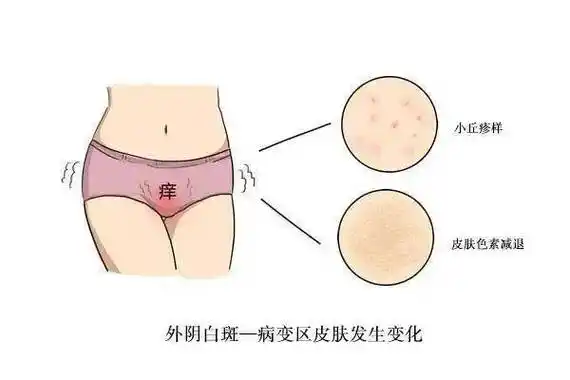 女科医话丨啥外阴瘙痒竟然是外阴营养不良惹的祸