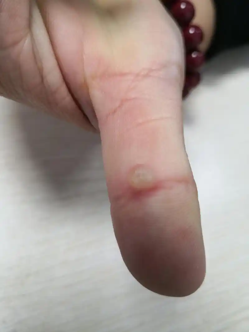 儿童手指寻常疣和臀部传染性软疣症状#皮肤##解决皮肤问题专注皮肤