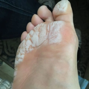 【城吧】老中医轻松教你治愈香港脚!