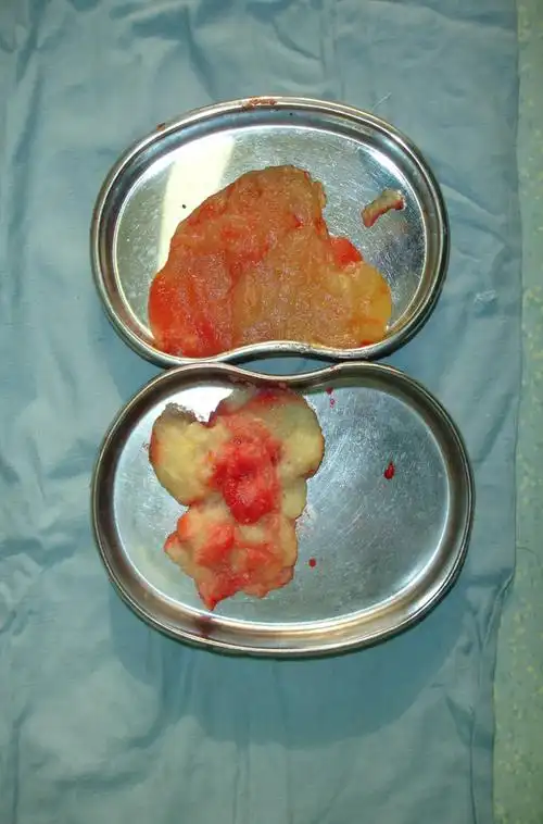 奥美定取出术前应该进行何种检查?