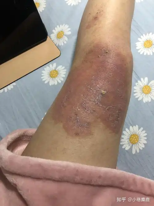 腿部被开水烫伤的恢复记录