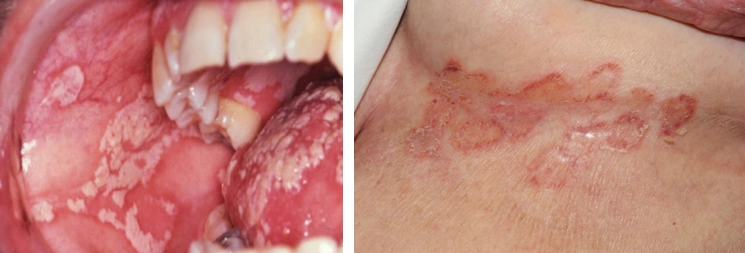 "人活一张脸,树活一张皮",关注hiv感染者的皮肤健康