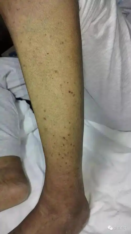 哪家好!白血病初期小血点图片"深入了解"-第2张图片-云飞博客