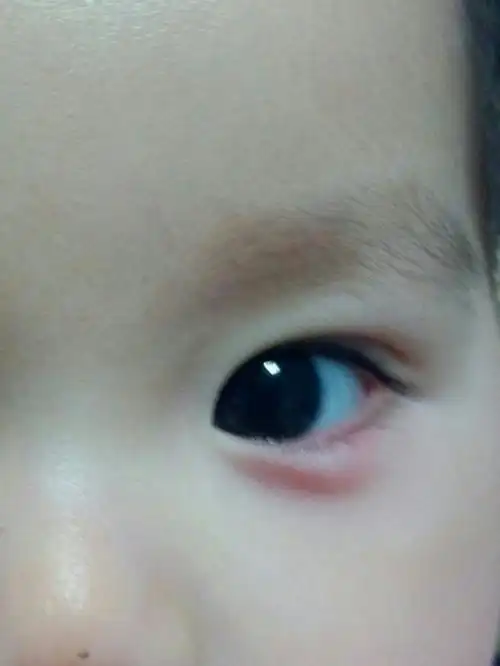 在线等回答~~ 宝宝九个多月,晚上宝宝左眼皮突然红肿,知道的大神们请