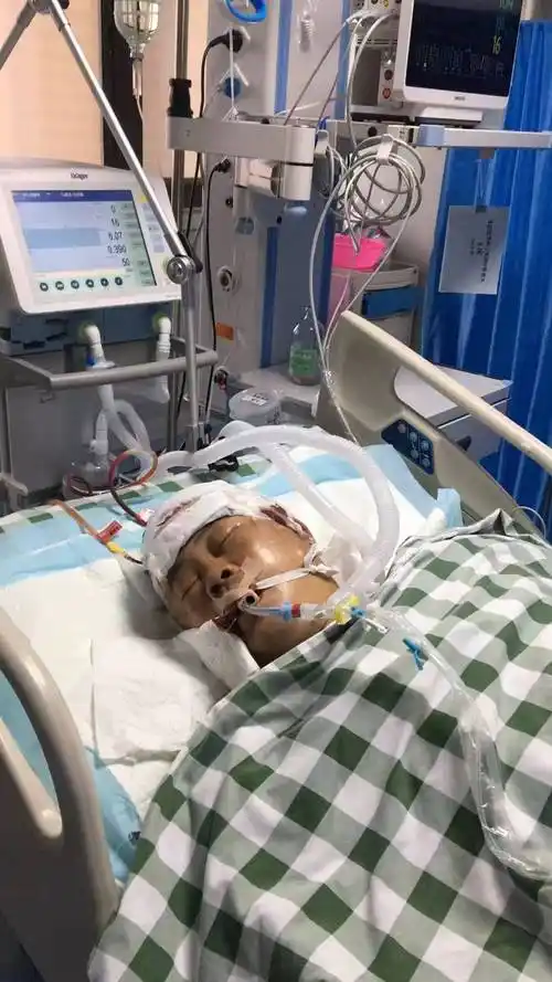开颅手术后进icu至今昏迷!救救他吧!
