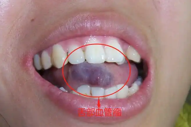 1,舌部血管瘤舌部血管瘤是一种良性肿瘤,舌头会出现大小不等的鲜红色