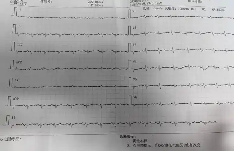 别慌,心电图带你抽丝剥茧找真凶|心电图_新浪财经_新浪网