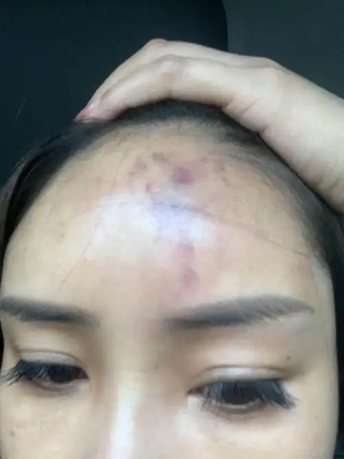 玻尿酸填充额头栓塞