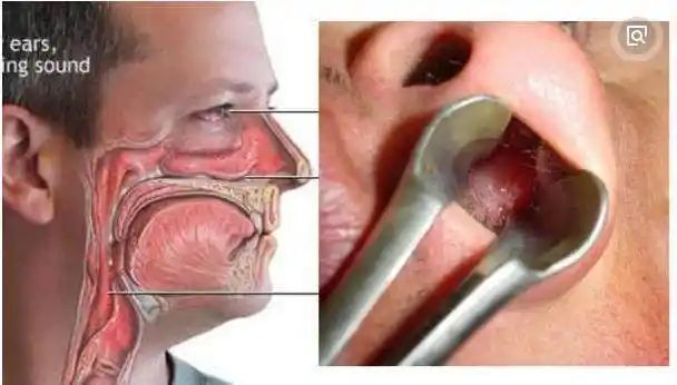 有鼻炎的人注意3种食物不能吃吃一口鼻子又塞又痒