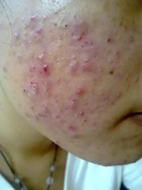 孕妇疥疮初期腹部皮肤症状图片