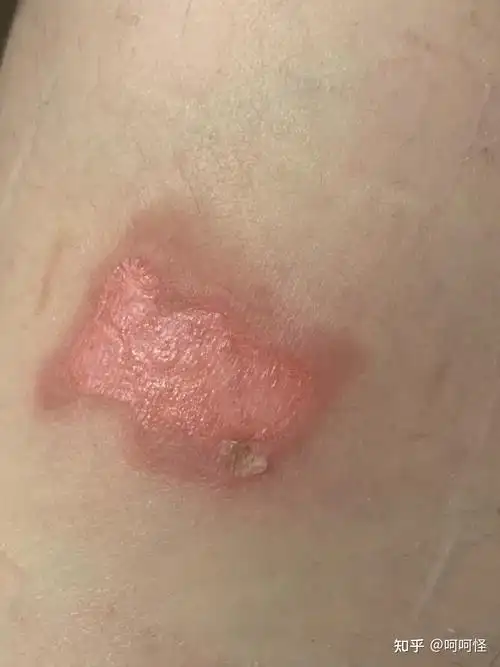 人生在世,磕磕碰碰难免,这次是深二度-三度烧伤的护理 - 知乎