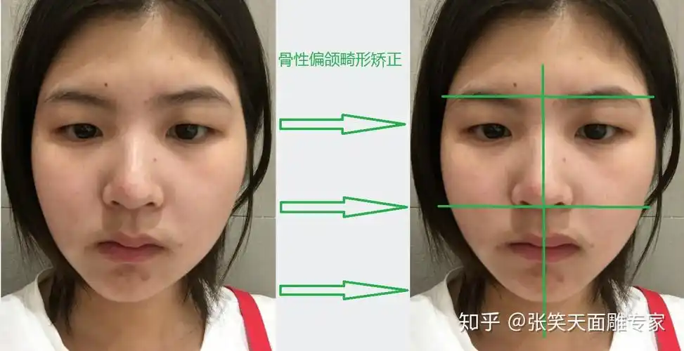 面部骨骼不对称? - 知乎
