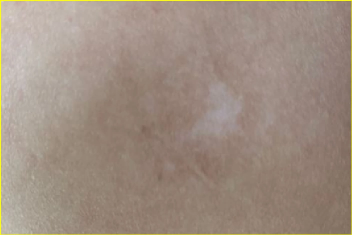 白斑初期症状图片/先来沙冲南路87号_贵阳白癜风皮肤病医院